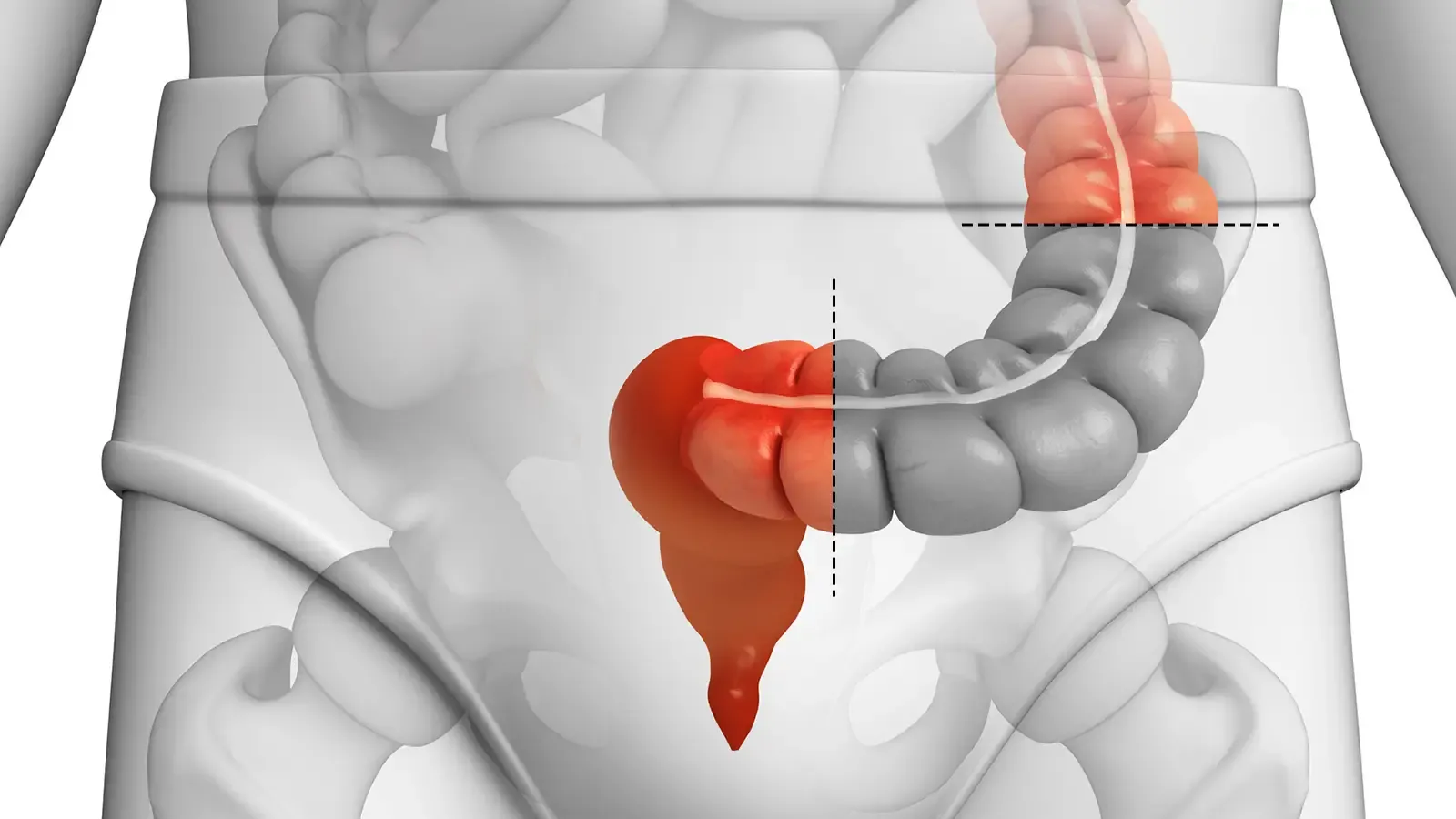 Elective Surgery for Diverticulitis tied to QOL Benefits, Fewer Recurrences